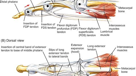 Central Slip Extensor Tendon Injury Injury Choices