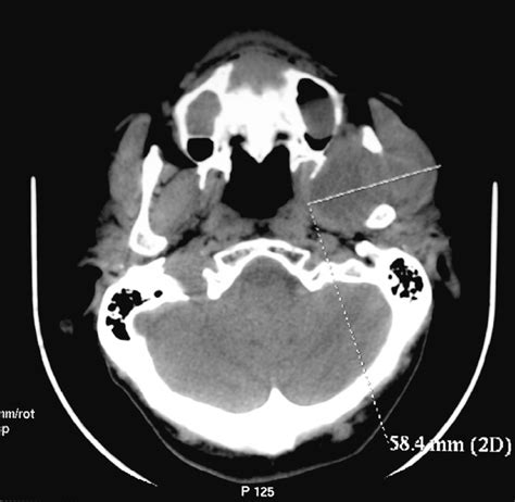 An Axial Postcontrast Computed Tomography Scan Shows That The Tumor Has