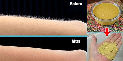 Remove Unwanted Hair Permanently At Home Permanently No Waxing Or