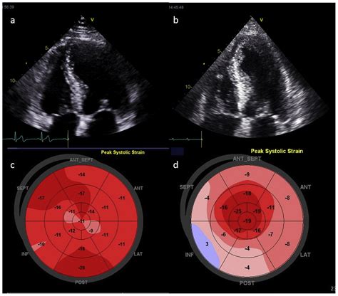 Hypertrophic Cardiomyopathy Challenging The Status Quo Heart Lung