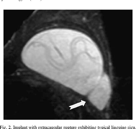 Pdf The Diagnosis Of Breast Implant Rupture Mri Findings Compared With Findings At