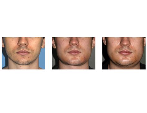 Swelling And Recovery After Custom Jawline Implant Surgery Explore