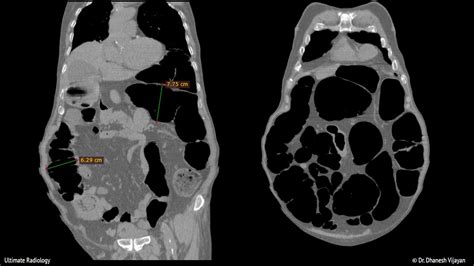 Ultimate Radiology Ogilvie Syndrome Or Acute Colonic Pseudo Obstruction