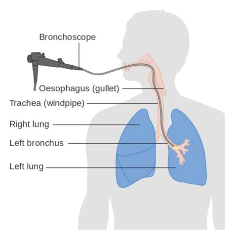 Interstitial Lung Disease Ild Respiratory Geeky Medics