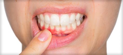 Stages Of Gum Disease Periodontist In Birmingham Al Gum Disease Treatment