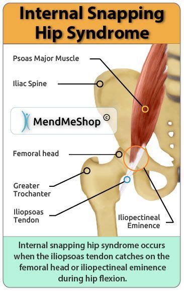Internal snapping hip syndrome occurs when the iliopsoas tendon catches