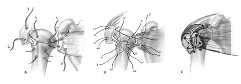 Schematic Representation Of Our Surgical Technique A Initial Passage