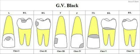 Gv Black Classification Of Dental Caries Dentário Escola De