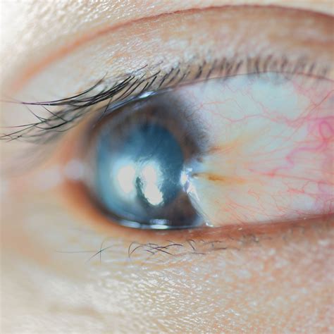 What Causes A Bump On The Eyeball
