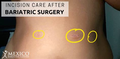 Incision Care After Surgery Healing And Recovery