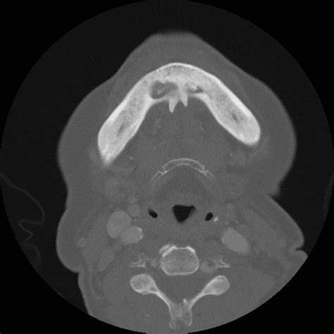 Mandibular Osteomyelitis Radiologypicscom