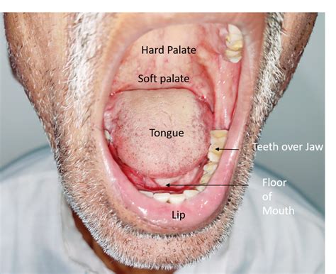 Pictures Of Early Signs Of Tongue Cancer