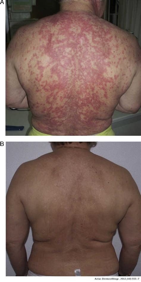 Refractory Subacute Cutaneous Lupus Erythematosus Treated With Rituximab Actas Dermo