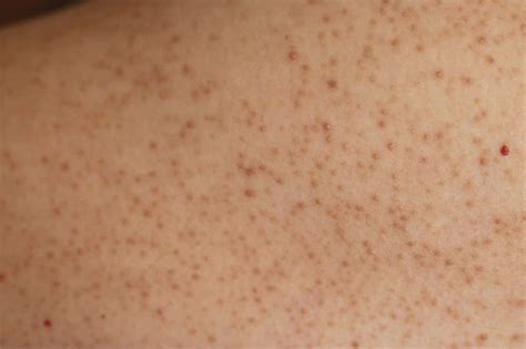 Keratosis Pilaris Before And After Top Skincare Products Skincare