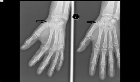 Plain Left Hand X Ray To Demonstrate The Presence Of