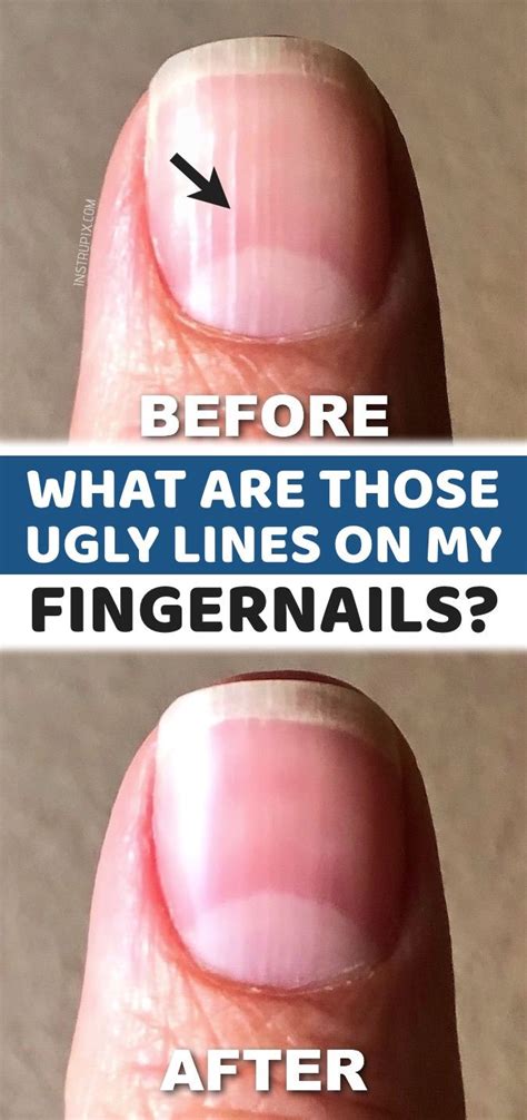 As Ive Gotten Older Those Vertical Ridges On My Nails Seem To Be