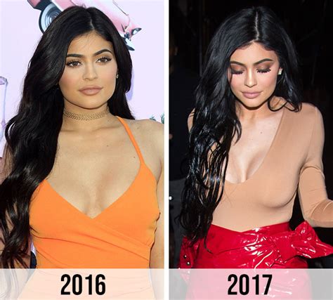 Kylie Jenners Comments Denying Plastic Surgery Go Viral In The Wake Of
