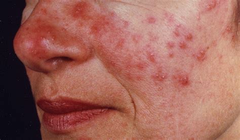 New Study Examines Differences Between Rosacea And Acne