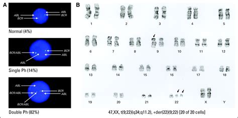 Molecular Response Of E19a2 Bcr Abl1 Chronic Myeloid Leukemia With Double Philadelphia