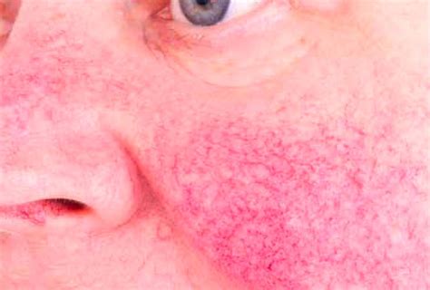 Rosacea Laser Nürnberg Dauerhafte Rötung Im Gesicht Entfernen Noris