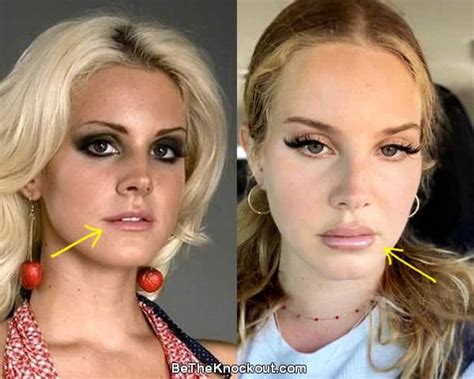 Lana Del Rey Plastic Surgery Comparison Photos