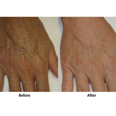 Pro Hand Hyperpigmentation And Age Spots