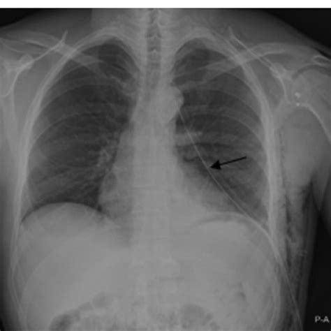 By Chest Tube Arrow Treated Pneumothorax The Pneumothorax Is No