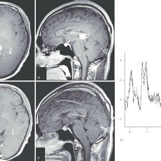 A And B Axial A And Sagittal B T Weighted Magnetic Resonance