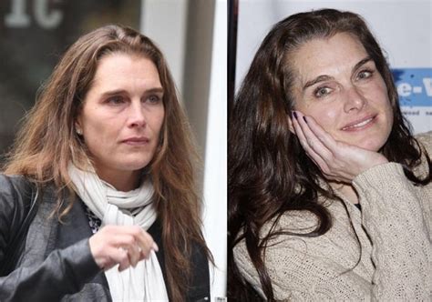 Brooke Shields Before And After Plastic Surgery