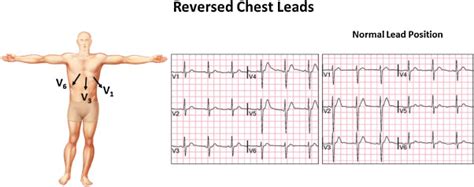 Twisted Leads The Footprints Of Malpositioned Electrocardiographic