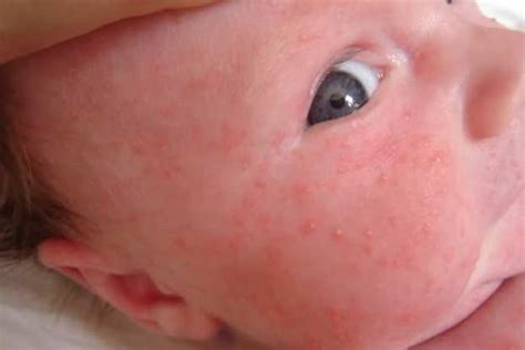 Infeksi ditandai dengan munculnya benjolan dan rasa gatal. Beberapa Kondisi Bintik Merah Pada Kulit Bayi | BlogDokter