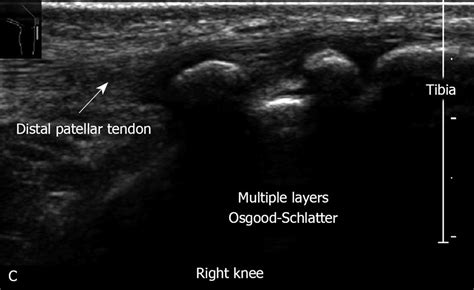 Ultrasound In The Diagnosis Of Clinical Orthopedics The Orthopedic