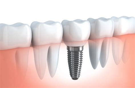 Dental Implants Abroad Full Guide All Answers Maltepe Dental Clinic