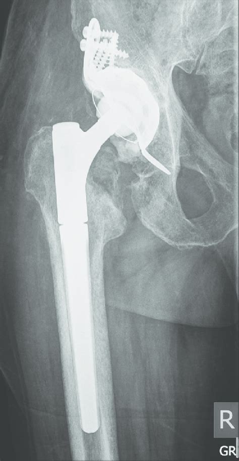 Anteroposterior Radiograph Of The Right Hip 1 Year After Prosthesis