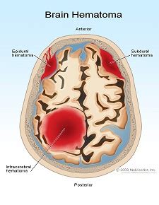 Complicaciones De La Hemorragia Cerebral Art Culos Intramed