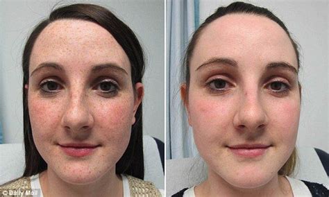 Before And After A New Craze For Having Freckles Removed Is Sweeping The Beauty World Sally