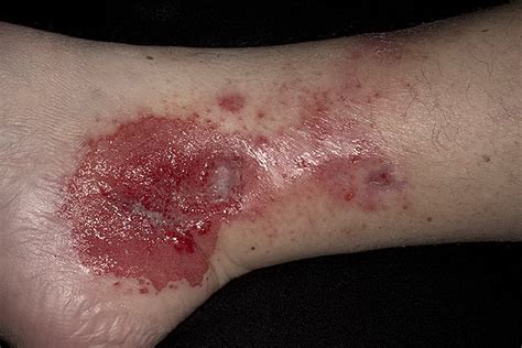 Contact Dermatitis In Adults Pictures 156 Photos And Images