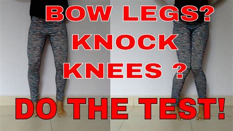 Bow Legs Test Bow Legs Or Knock Knees What Do You Have Youtube