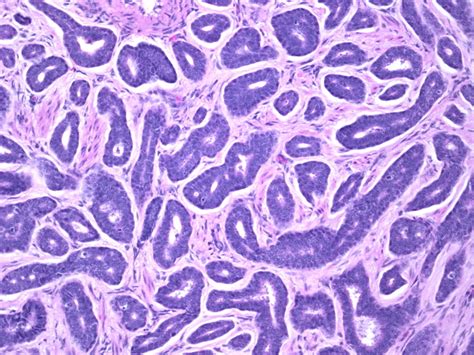 There are three main growth patterns at histology Webpathology.com: A Collection of Surgical Pathology Images