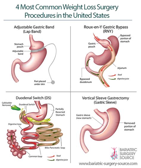 The Types Of Bariatric Surgery You Should Consider Depend On A Number