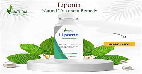 Natural Lipoma Treatment Home Remedies You Can Try Today