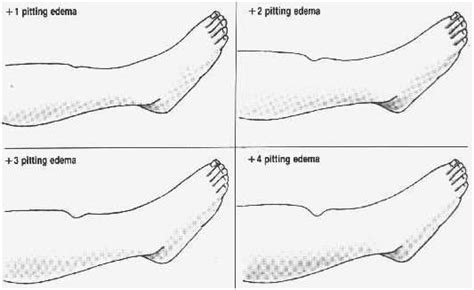 Edema Grading Scales Of Pitting Edema Image Search Results Cardiac