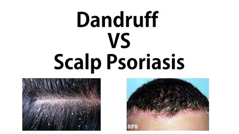 Psoriasis Vs Dandruff How To Tell The Difference Youtube