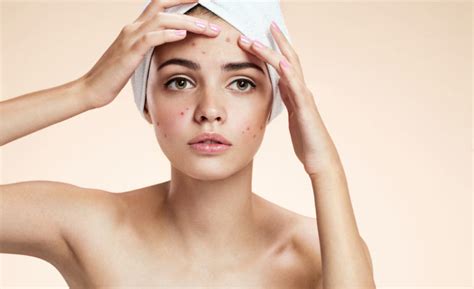 Basics And Treatments For Female Hormonal Acne Skintherapy