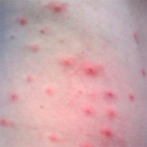 Novel Treatments For Chronic Itch Eczema And Skin Infections Suzy