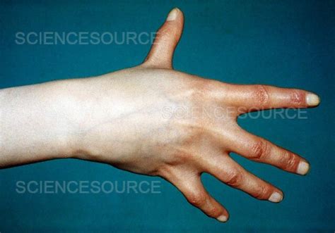 Photograph Klinefelter S Syndrome Science Source Images