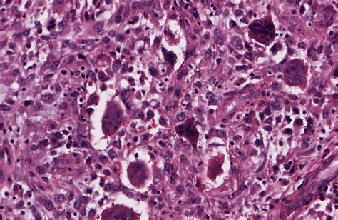 Pathology Outlines Anaplastic Thyroid Carcinoma