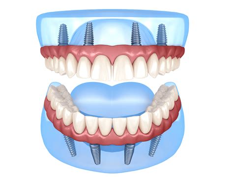 Dental Implants in Mexico - #1 Amazing Results by Dr Moguel