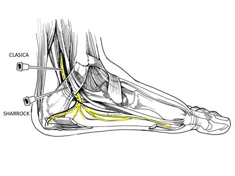 Nervio Tibial Ramas