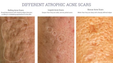 Adapalene 03 May Help Improve The Appearance Of Atrophic Acne Scars